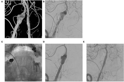 Flow Diverter in Unruptured Intracranial Vertebral Artery Dissecting Aneurysm